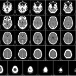 640px-Computed_tomography_of_human_brain_-_large-150x150.png